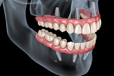 Rendering of all-on-4 dentures in translucent white jaw with black background
