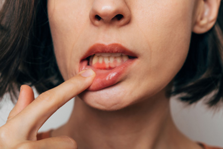 Woman with gum irritation