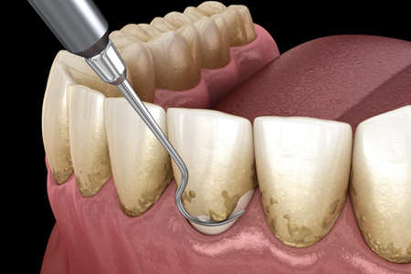Digital illustration of scaling & root planing