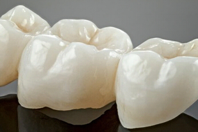 dental bridges