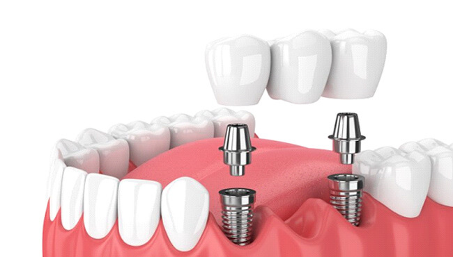 illustration of implant bridge