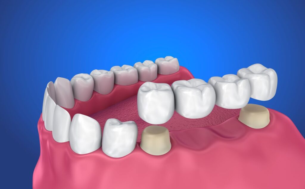 A dental bridge.